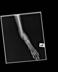 A "craniocaudal" view of Grey's leg showing the fracture.